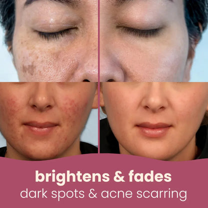 Turmeric & Kojic Acid Whitening Soap Bar